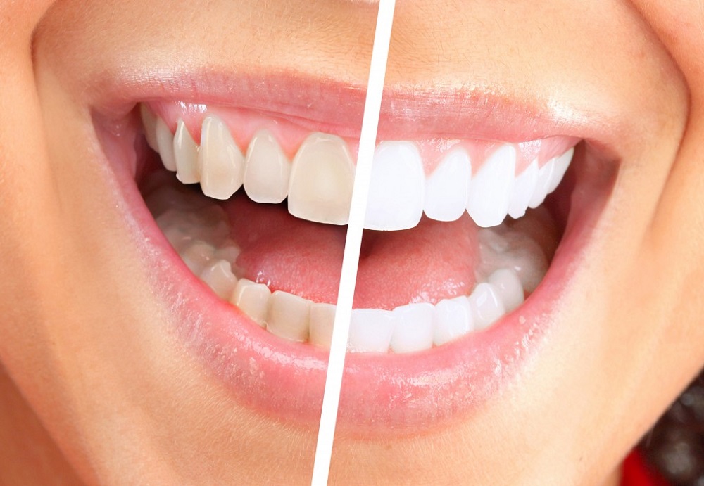 Cosmetic Smile Solutions For Summer