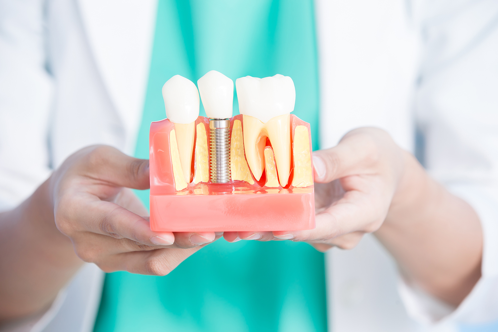 What’s So Great About Dental Implants?