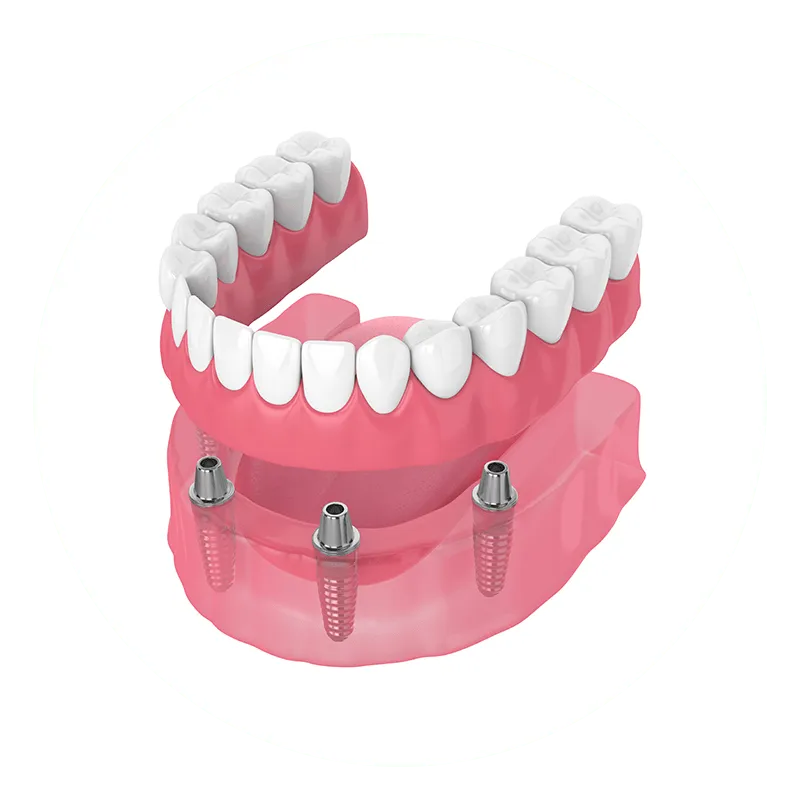 Full Arch/Full Set of Teeth Full Arch/Full Set of Teeth