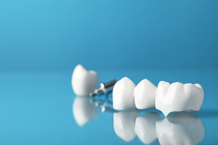 Restore Your Smile with Dental Crowns and Bridges in Carmel, IN