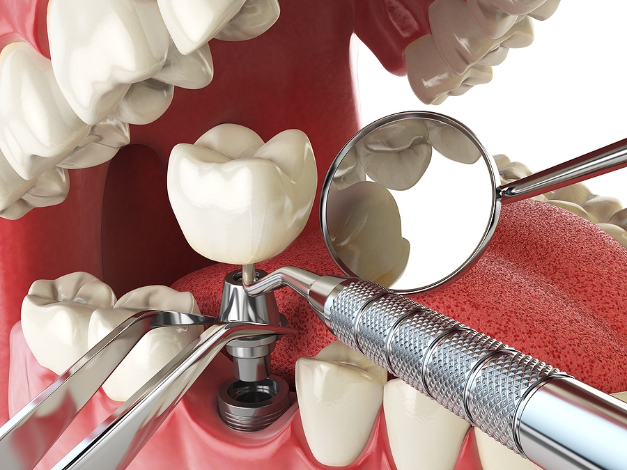 Revitalize Your Smile with Dental Implants in Carmel, IN