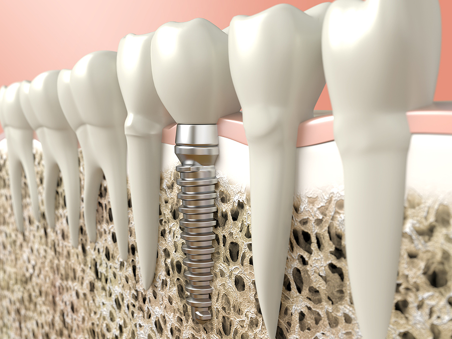 Transform Your Smile with Dental Implants in Carmel, IN