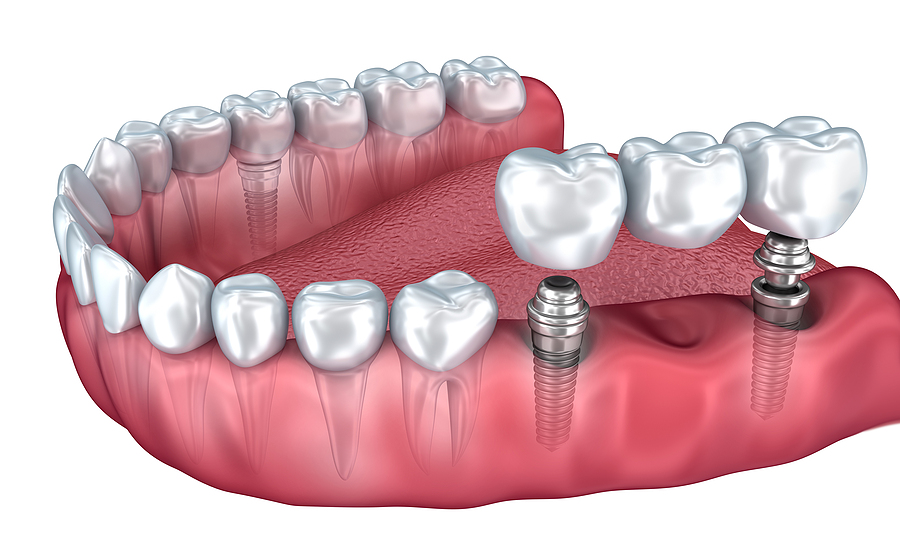 The Benefits and Process of Dental Implants in Carmel, IN: A Complete Guide