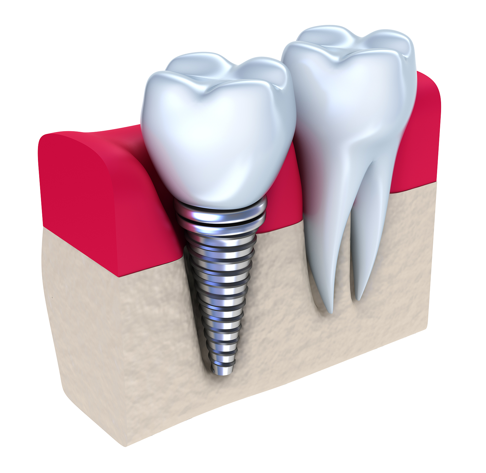The Ultimate Guide to Dental Implants in Carmel, IN: What You Need to Know