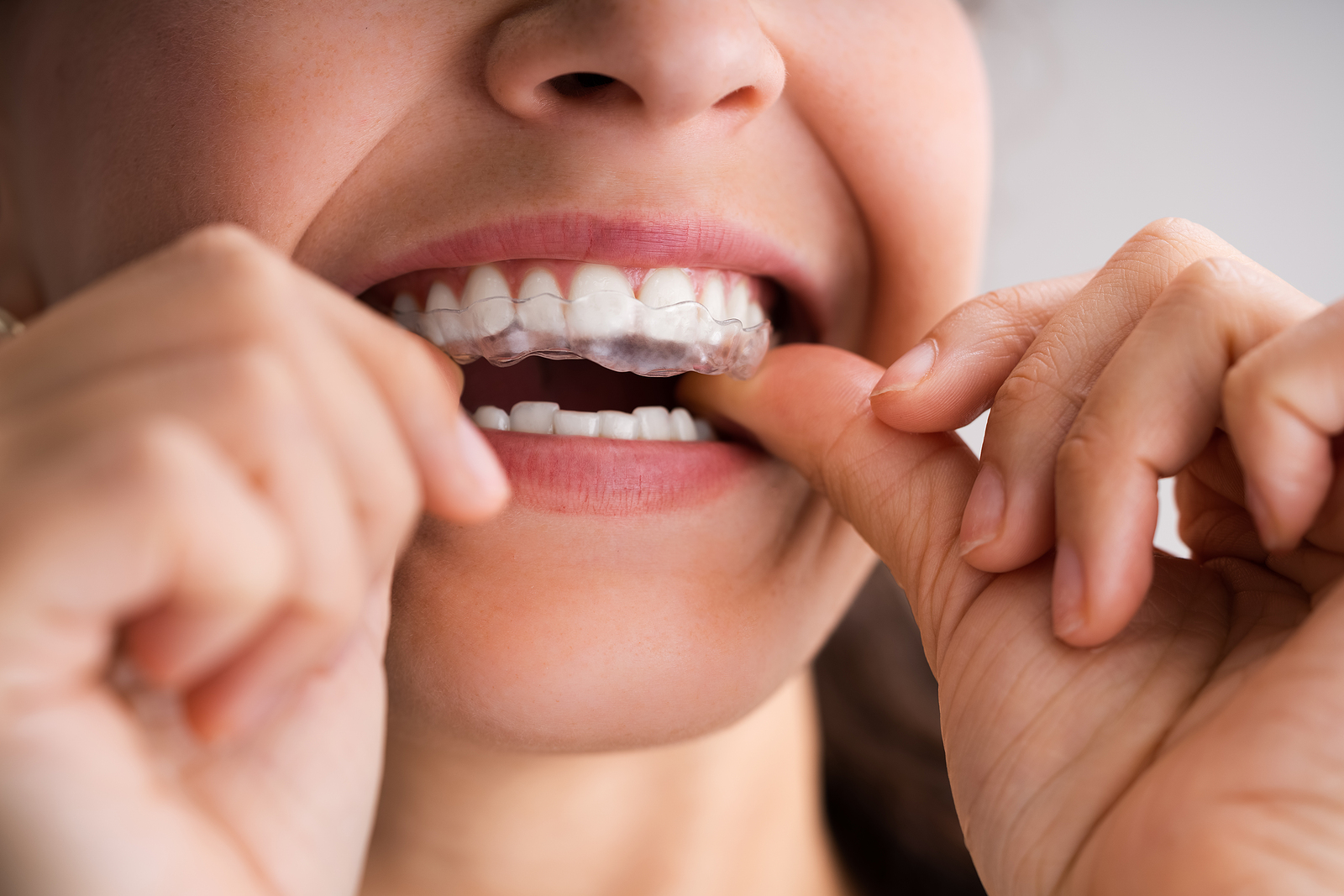 Top Benefits of Invisalign