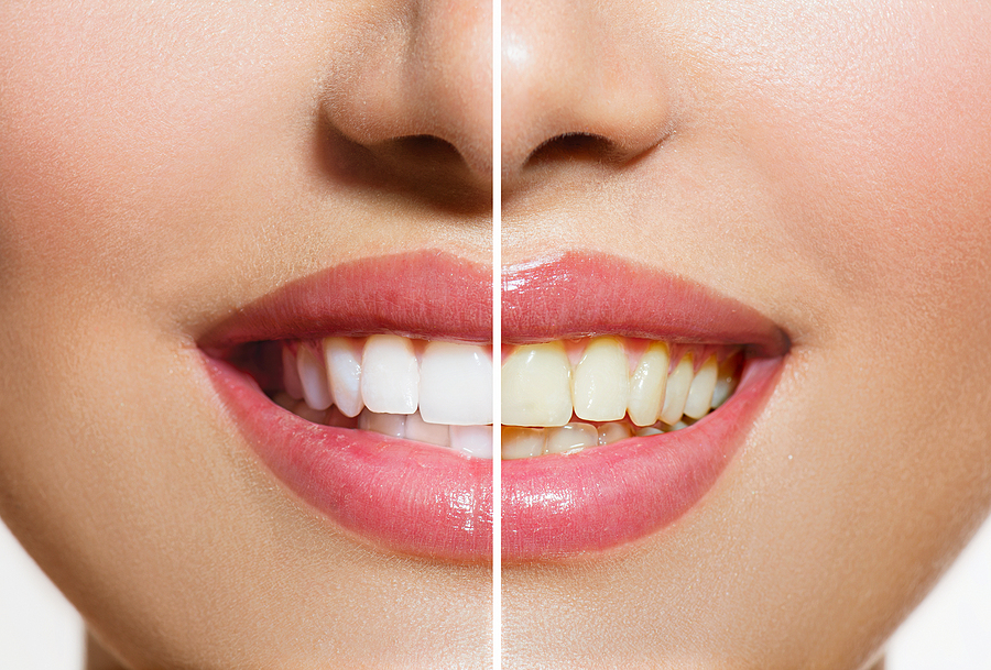 Achieve a Brighter Smile: The Benefits of Professional Teeth Whitening